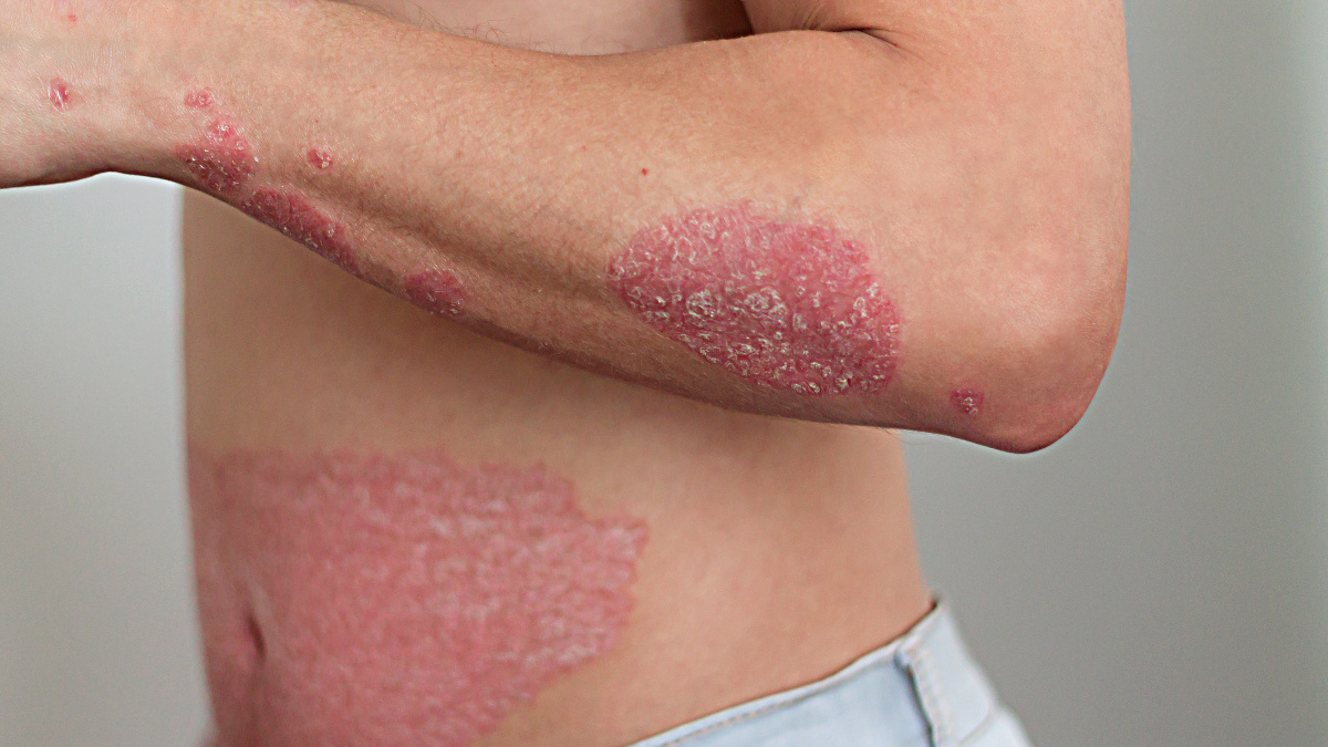 Psoriasis op de arm en de buik 